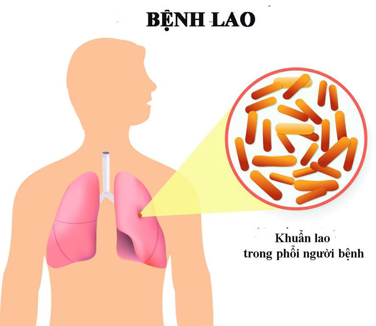 Bệnh Lao Wiki: Tổng Quan Thông Tin Cần Biết